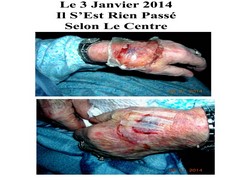 Le3Janvier2014IBlessureMainIlNeS'EstRienPasse