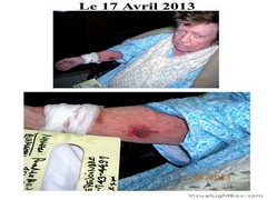 Le17Avril2013BrasDroit
